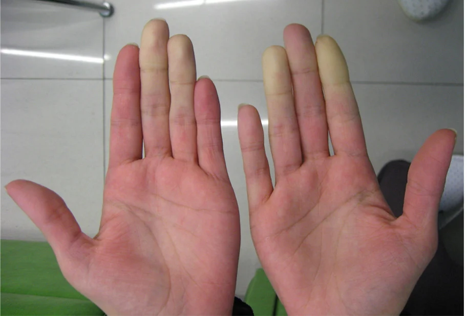 Hand-Arm Vibration Exposure
